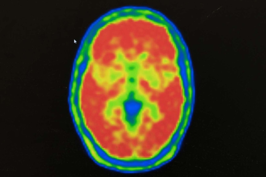 The red zones of Karen Cooke's brain indicate the Amyloid build up.