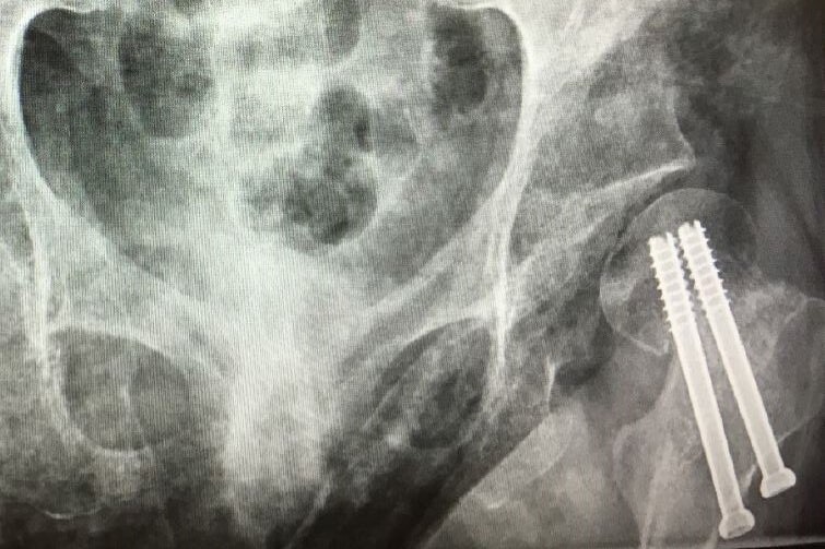An x-ray shows Eden Camac's hip six weeks after surgery.