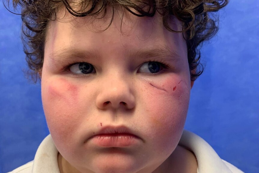 Boy looks sad with cuts and bruises on his face