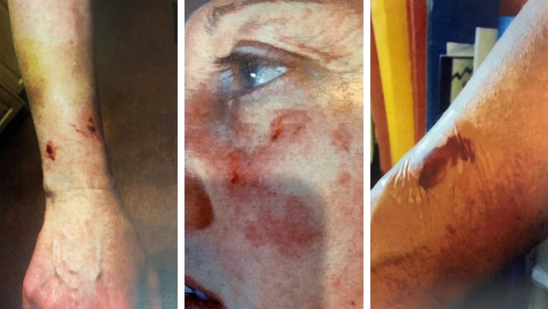 A composite photo of scratches and bite marks on a woman's face and arms.