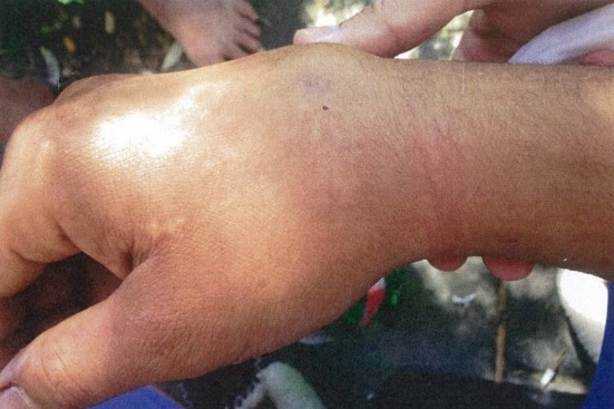 Jia Meeks' swollen, injured hand.