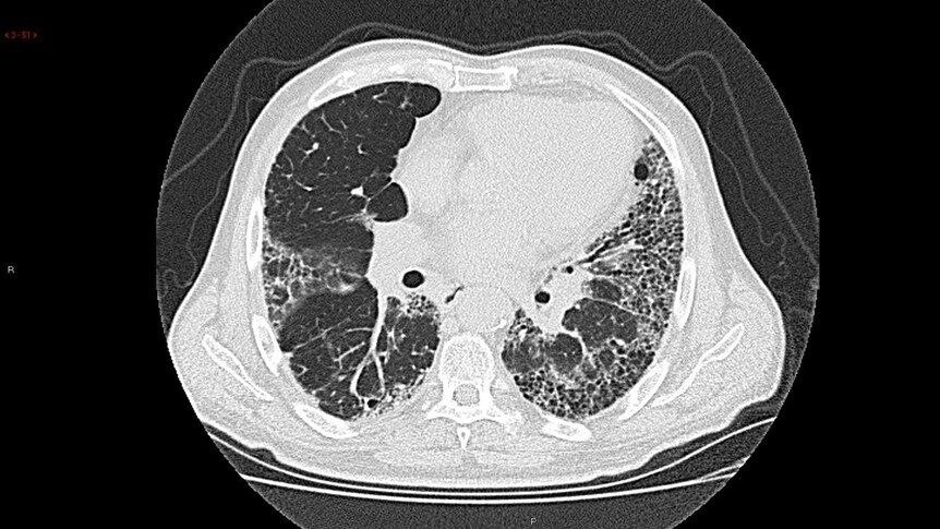 The CT scan of a lung diseased with IPF.