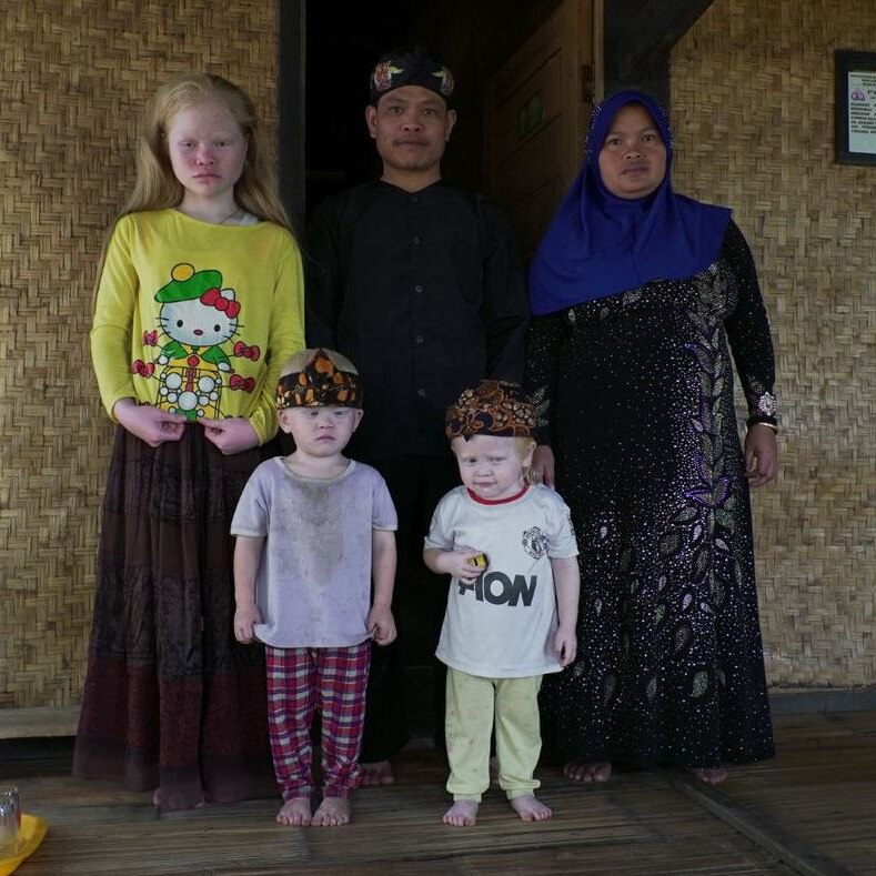 Family with three albino children living in the Indonesian village of Ciburuy, where there is a high instance of albinism