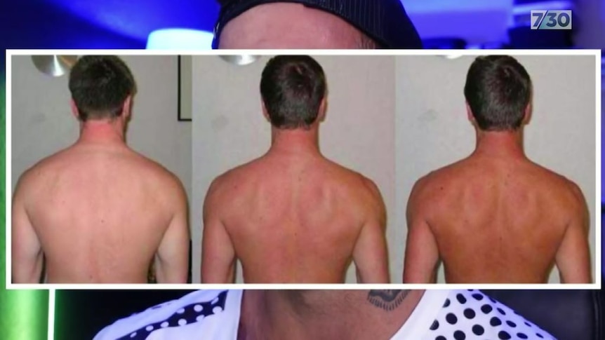 barbie drogen melanotan Melanotan-II is the product that's been dubbed the "Barbie drug" on social media, and promises to give users a tan without the sun but it can have serious side effects including Health warning issued over illegal