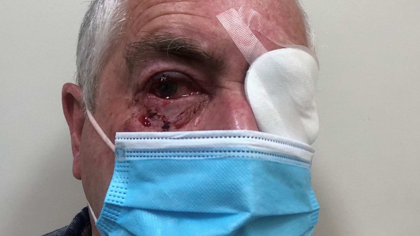James Glindemann pictured with a bandage over his left eye and blood dripping from his right eye.