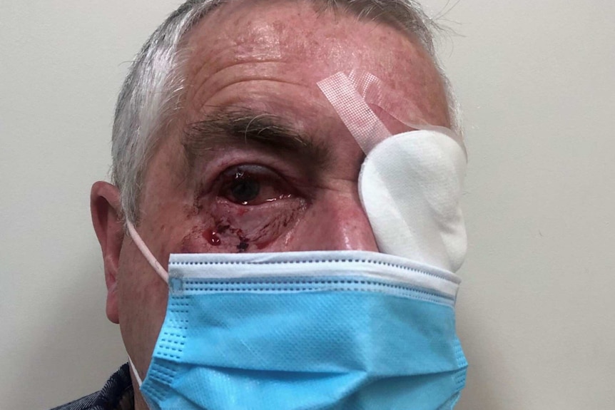 An older man with a bandage over his left eye and blood dripping from his right eye.