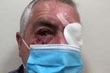 James Glindemann pictured with a bandage over his left eye and blood dripping from his right eye.