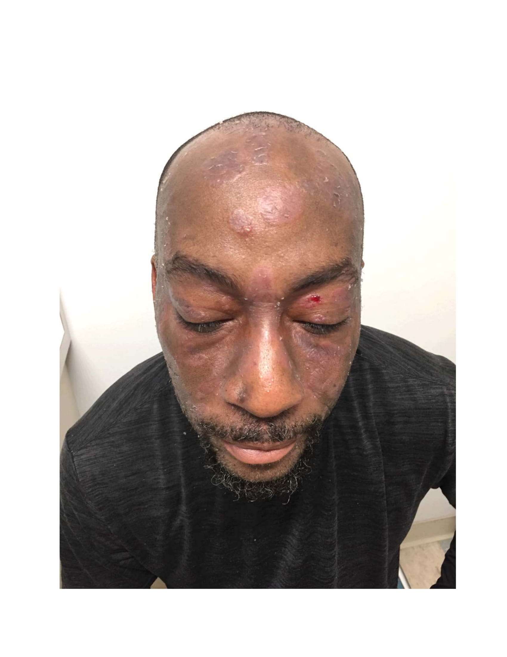 Cancer Council calls for Roundup review after dying man wins $400m payout