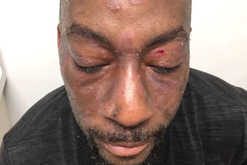 Dewayne Lee Johnson shows the lesions on his face and scalp.