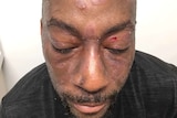 Dewayne Lee Johnson shows the lesions on his face and scalp.