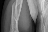 An x-ray of a fractured humeral bone