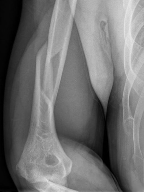 An x-ray of a fractured humeral bone