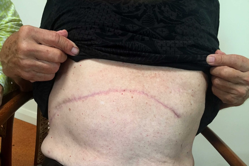 A large scar from a surgical procedure known as a 'Whipple'.