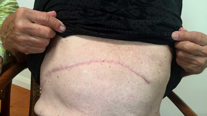 A large scar from a surgical procedure known as a 'Whipple'.