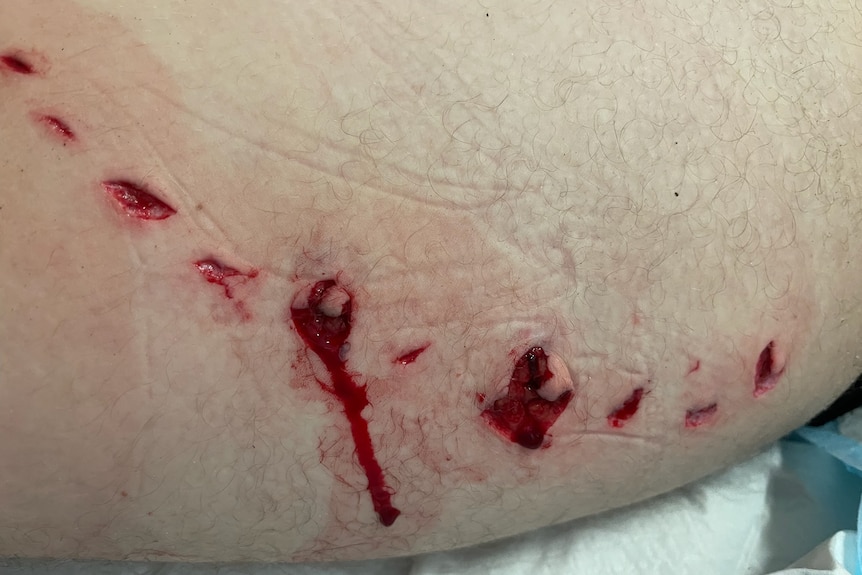 A close up of shark puncture wounds on a teenagers thigh.