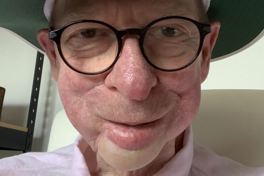 John Blackman in a selfie showing his recovery from cancer surgery on his chin. He is similing and wearing a broad-brim hat 