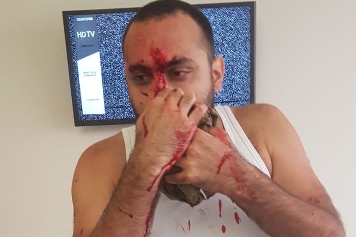 A man holds his nose with blood covering his face as he stands in a hospital room.