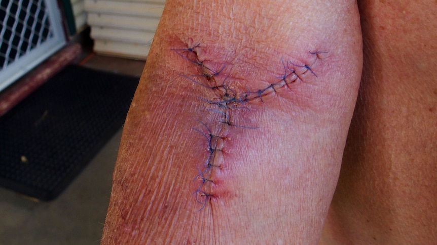 A man's elbow with a surgical scar and stitches.