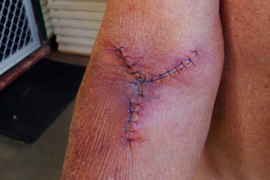 A man's elbow with a surgical scar and stitches.