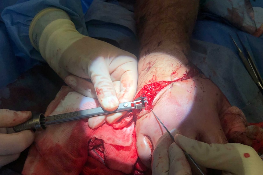 A hand partially attached to a wrist is operated on by a gloved surgeon's hand.