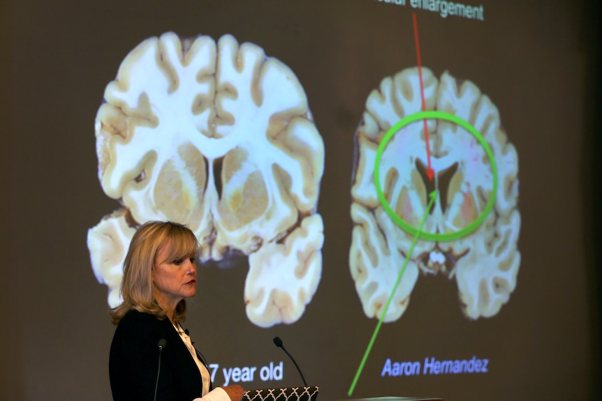 CTE scan of NFL player Aaron Hernandez's brain
