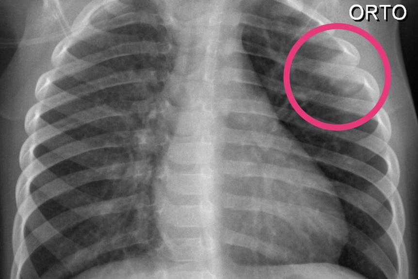 An x-ray of an 18-month-old boy from Italy shows COVID-19 pneumonia.