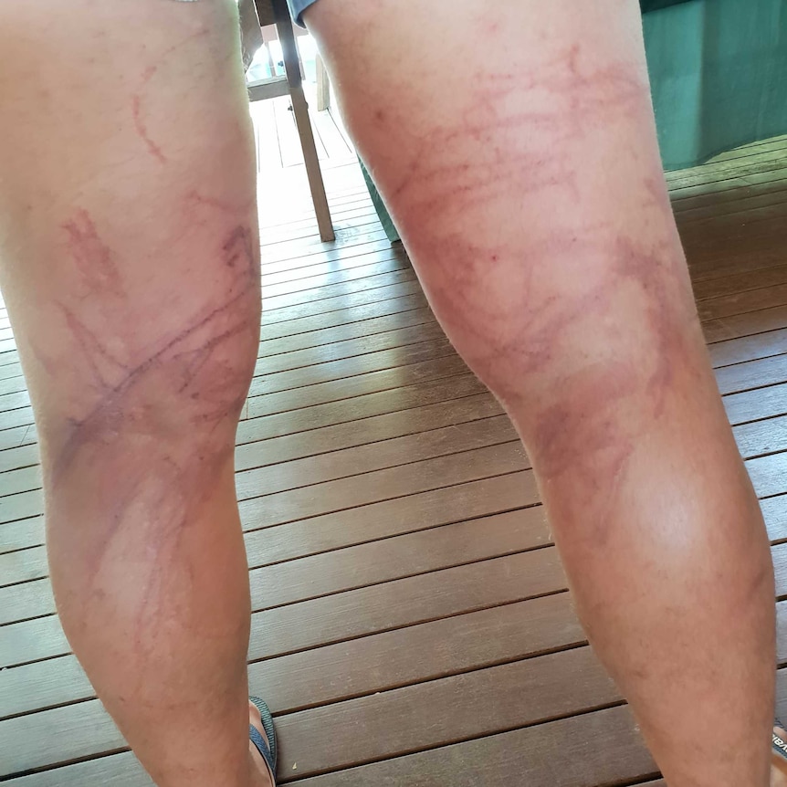Man with box jelly fish stings on his legs