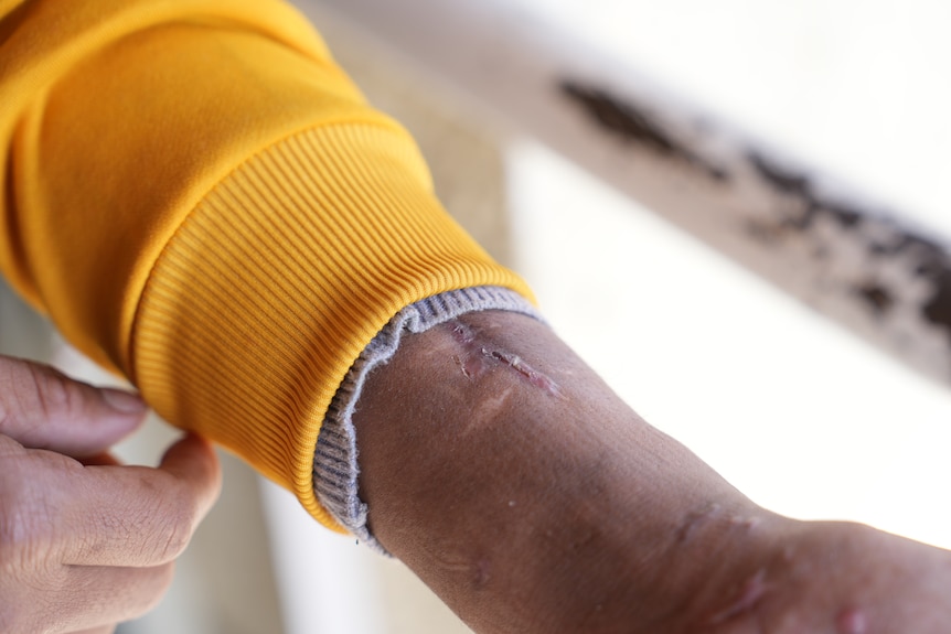 A man pulls up his jumper to show a wound on his wrist 