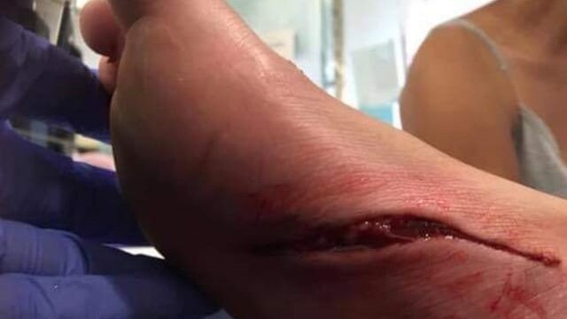 A person's foot with a deep, bloody gash under the side underneath.