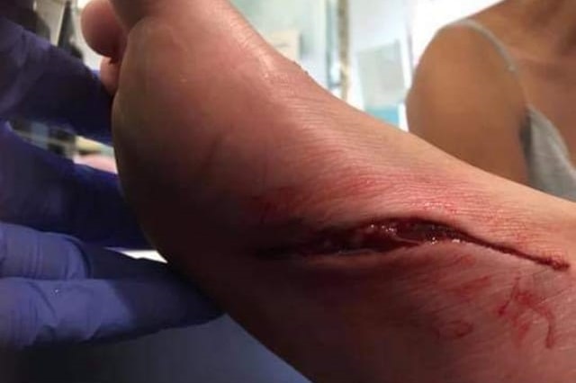 A person's foot with a deep, bloody gash under the side underneath.