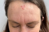 A woman with a carcinoma on her forehead close up.
