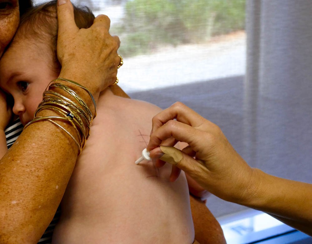 A baby being held with an arm around her head and a line with dots on her back. A white peg is being pushed on their back. 