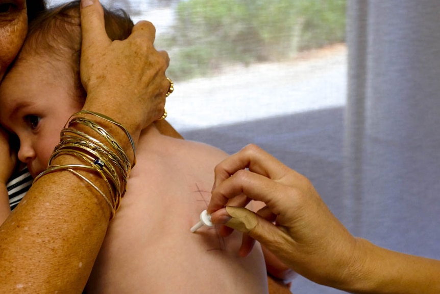 A baby being held with an arm around her head and a line with dots on her back. A white peg is being pushed on their back. 