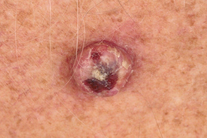 A close up of an unsightly wound on light skin surrounded by hair on a human body.