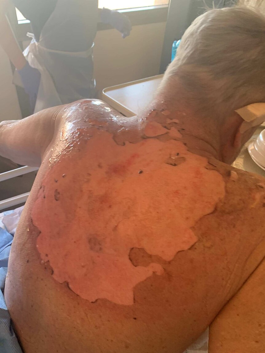 Man with a severely burnt back.