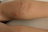 A child's legs covered in bites from bed bugs.