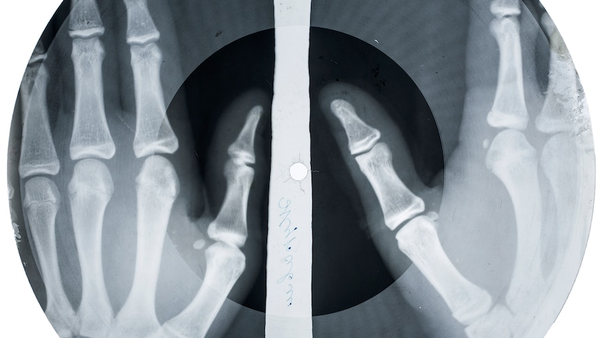 Bone disc on an X-ray of someone's hands 
