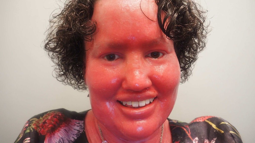 Close-up of Carly Findlay, who has ichthyosis.