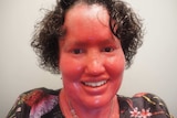 Close-up of Carly Findlay, who has ichthyosis.