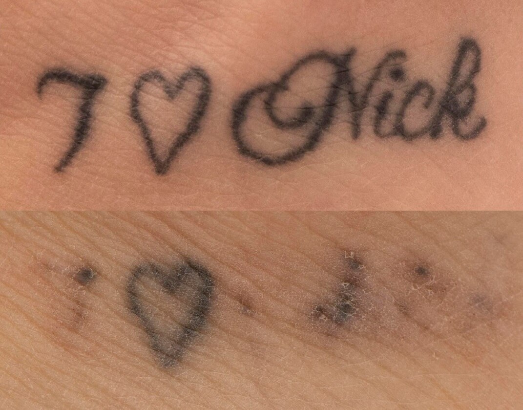 Tattoos Increasing In Popularity Along With Demand To Have Them Removed Abc News