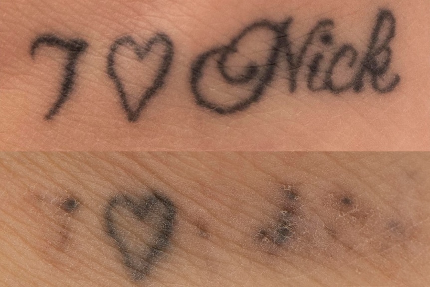 Picture of Skin with I love Nick and below an image of faded ink with a heart visible