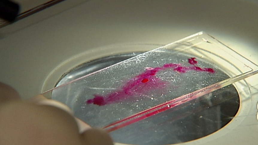 Breast cancer sample on glass slide