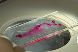 Breast cancer sample on glass slide