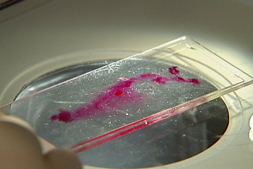 Breast cancer sample on glass slide