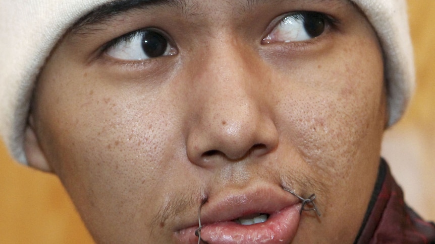 A prisoner on a hunger strike with his mouth sewn with a wire at a prison in Bishkek.