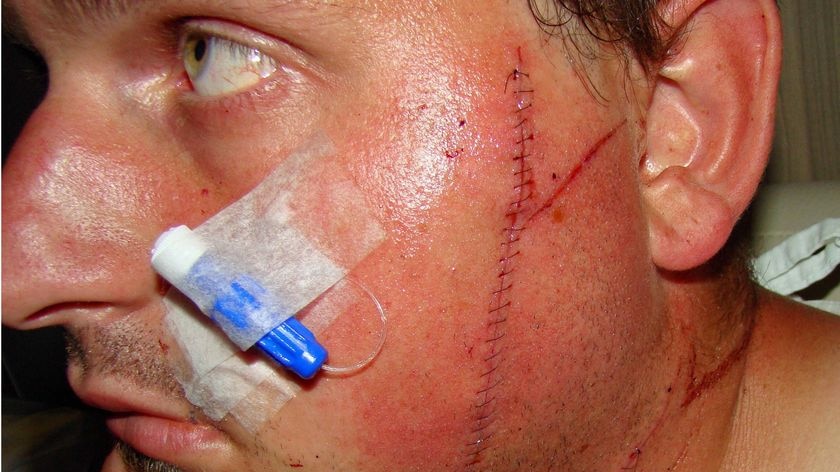 Andrew Katz suffered facial injuries in the attack.