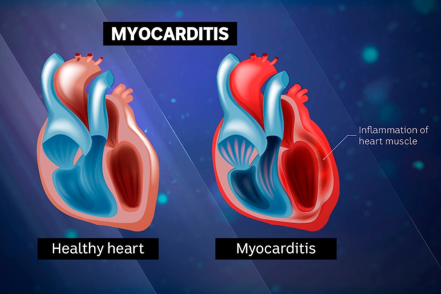 A graphic showing a healthy heart next to one with myocarditis, which is illustrated with a red, inflamed muscle.