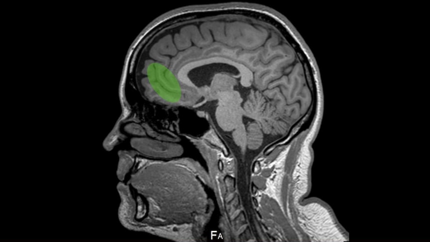 Image showing a human brain