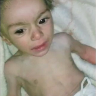 A malnourished baby in Madaya in Syria