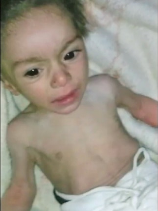 A malnourished baby in Madaya in Syria